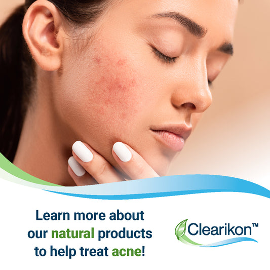 Learn more about our natural products to help treat acne! Image is of woman with acne on her face.