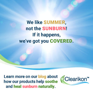 Treating Sunburn Naturally