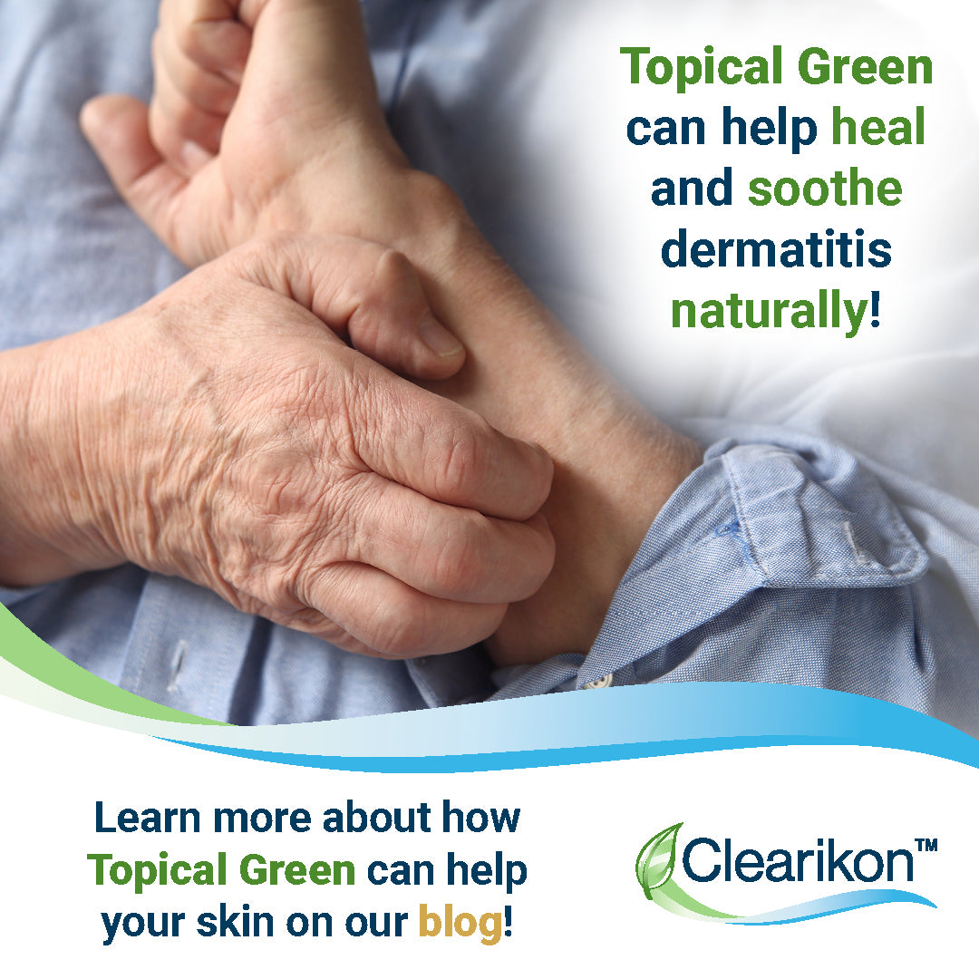 Topical Green can help heal and soothe dermatitis naturally! Learn more about how Topical Green can help your skin on our blog! Image is of someone's hand itching.